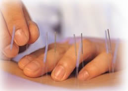 Fine Acupuncture & Herbs Clinic  - Acupuncture Treatment Image